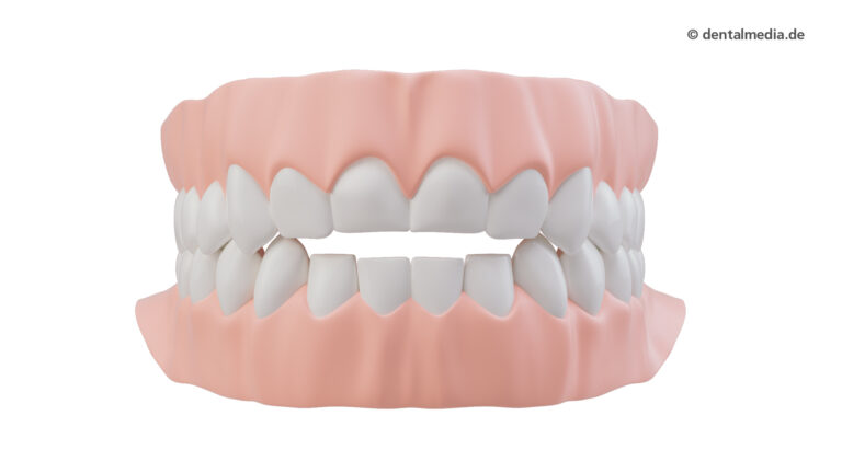 Zahnfehlstellung offener Biss