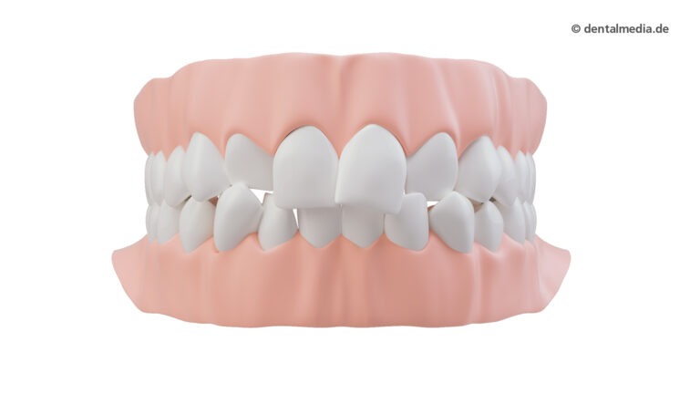 Zahnfehlstellung Platzmangel