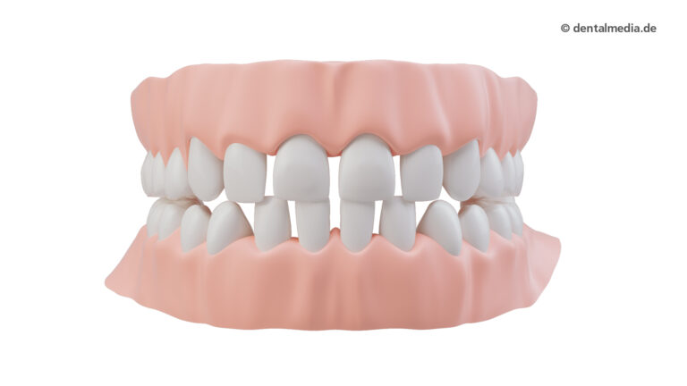 Zahnfehlstellung Platzüberschuss